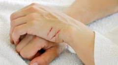 Prva pomoć u ugrizu i ogrebotinama